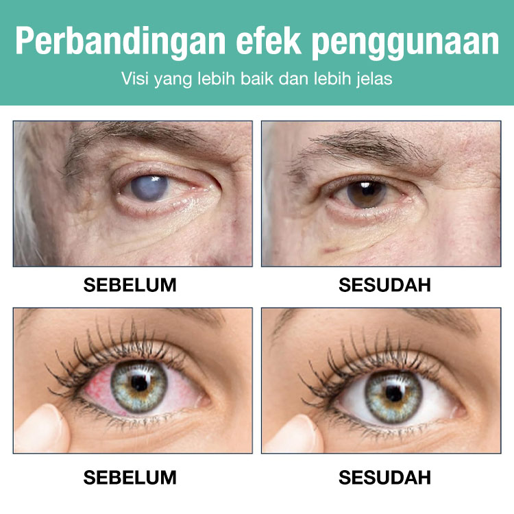 Promosi Idul Adha-Beli 1 Gratis 1 - Rol peningkatan penglihatan - Ucapkan selamat tinggal pada ketidaknyamanan mata dimulai hari ini!